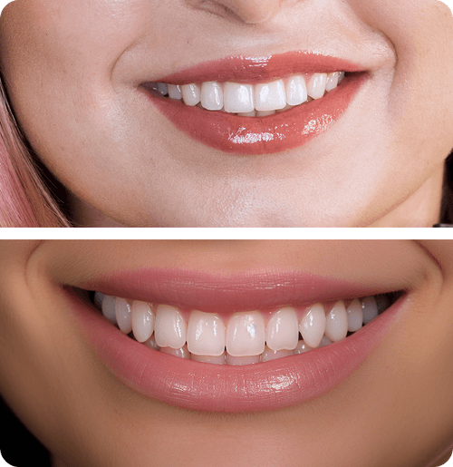 Types of Veneers: Porcelain vs Composite Explained