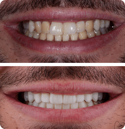 Porcelain vs Composite Veneers – Which Is Better for You?