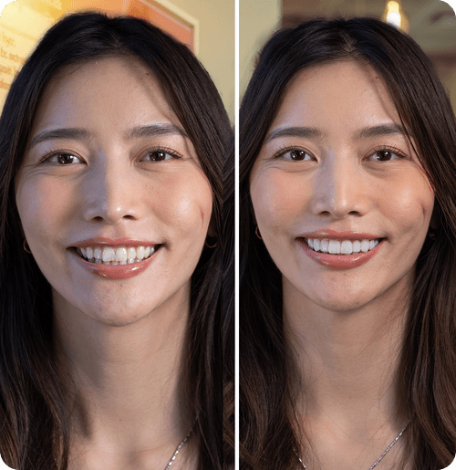 Before & After Veneer Transformations: Real Smile Stories