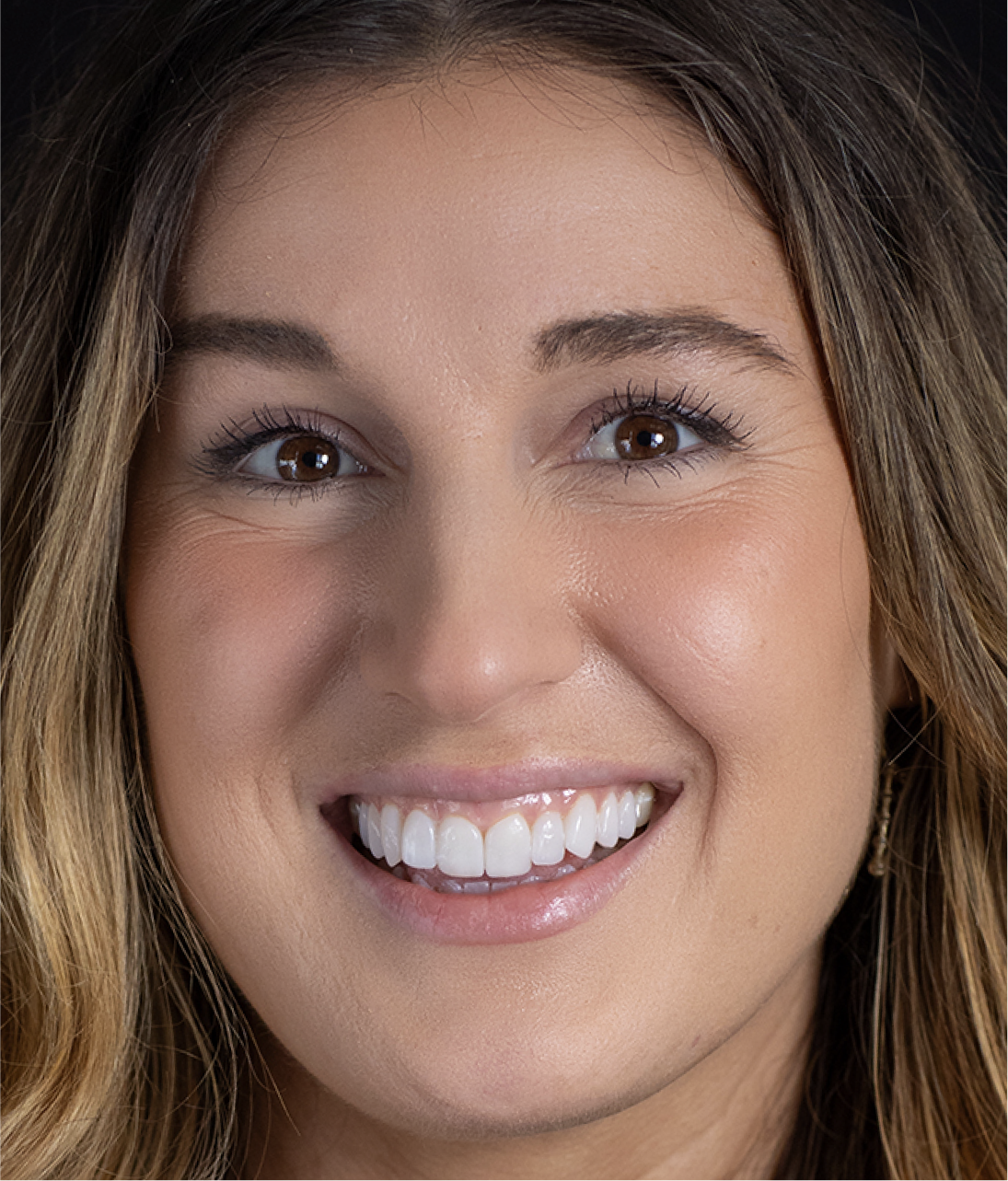 Close-up of woman smiling with Neer veneers