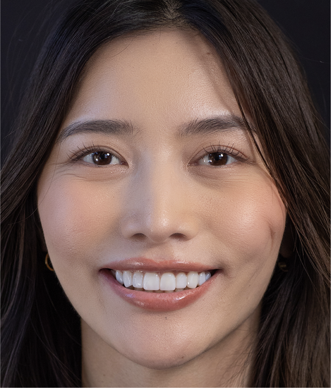 Close-up of woman smiling with Neer veneers
