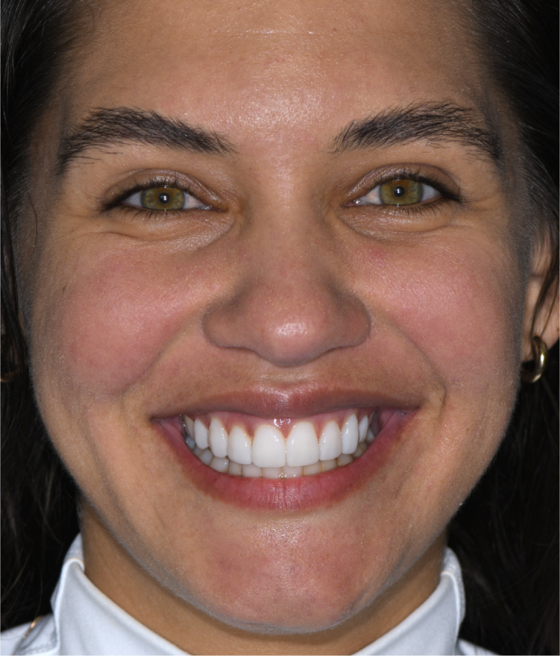 Close-up of woman smiling with Neer veneers