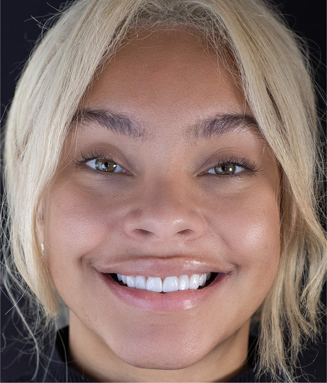 Close-up of woman smiling with Neer veneers