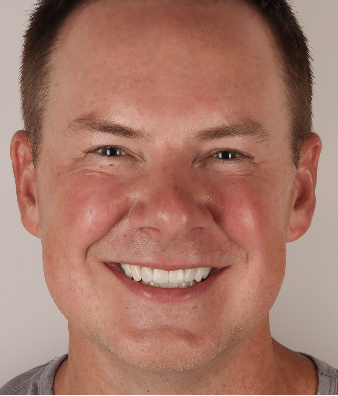 Close-up of man smiling with Neer veneers